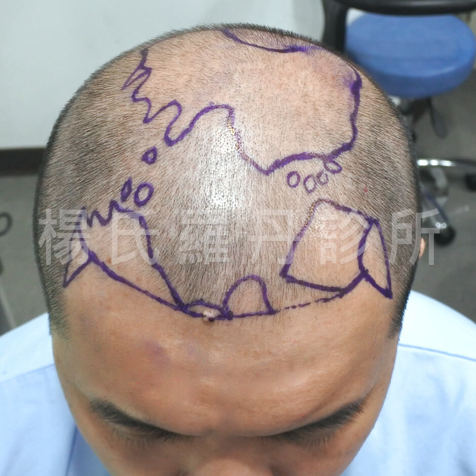 植髮 落髮 禿頭